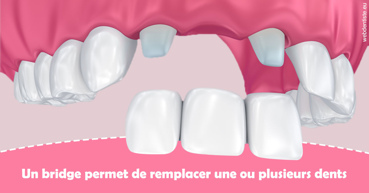https://www.docteur-lamoureux-jean-claude.fr/Bridge remplacer dents 2